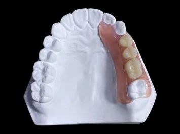 Flexible Valplast-Prothese aus thermoplastischem Kunststoff - metallfreie, zahnfleischfarbene Interimsversorgung.